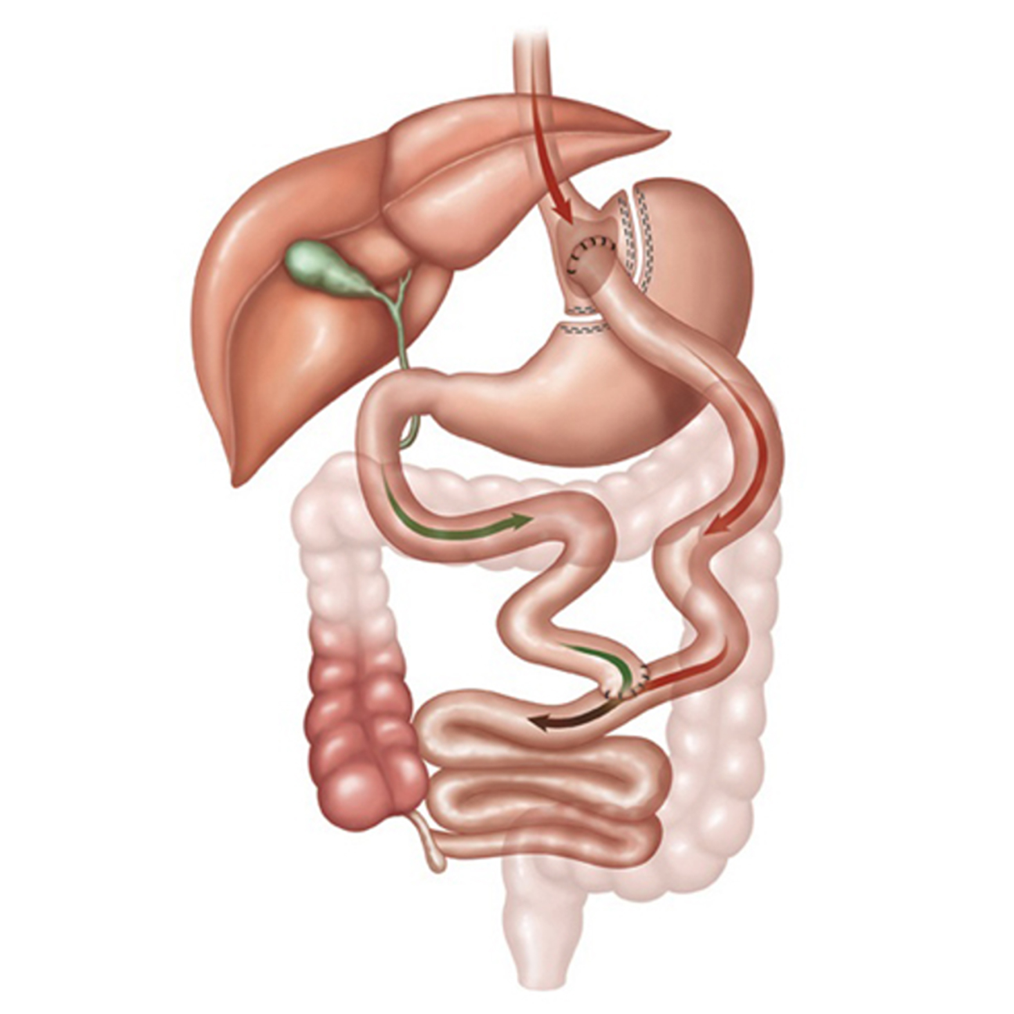 Roux-en-Y-Gastric-Bypass Roux en Y Gastric Bypass