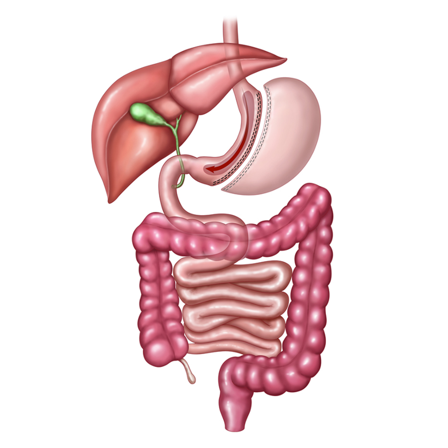 Sleeve-Gastrectomy Vertical Sleeve Gastrectomy