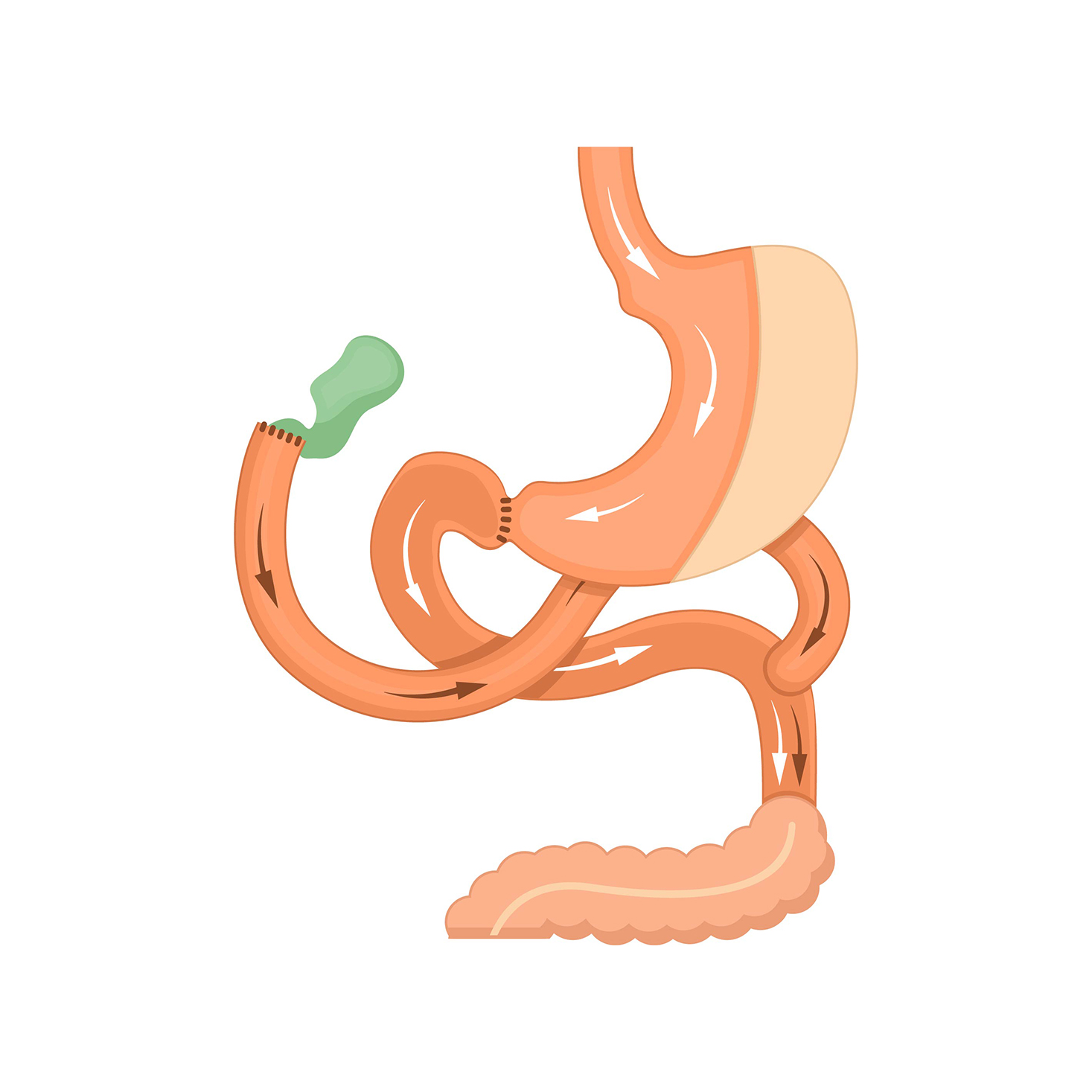 Biliopancreatic Diversion with Duodenal