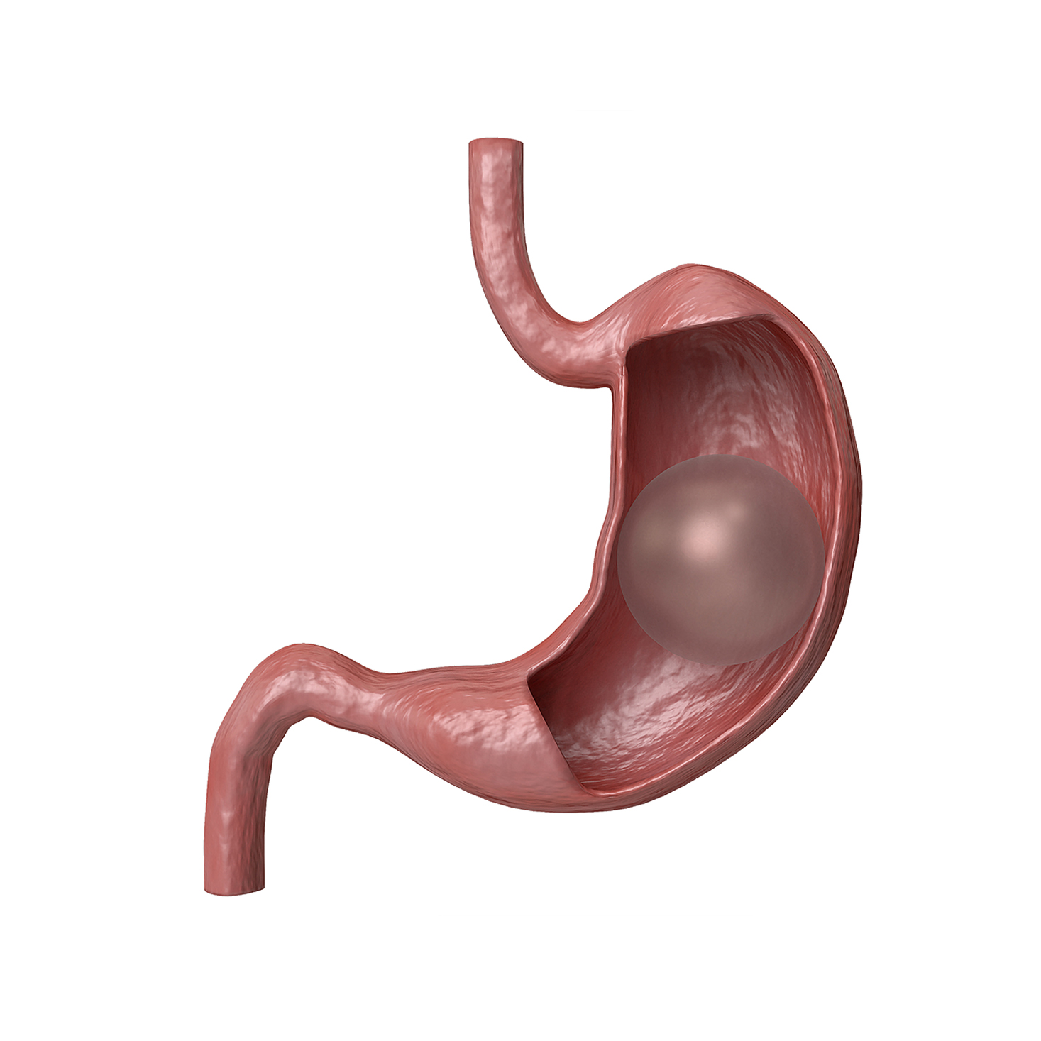 gastric-balloon